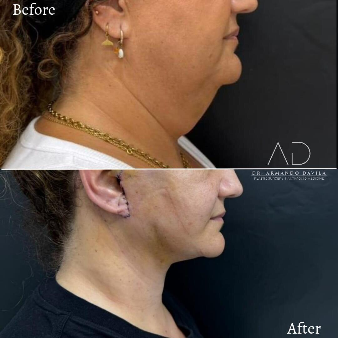 Antes y después de un minilift Deep Plane con reducción cervical