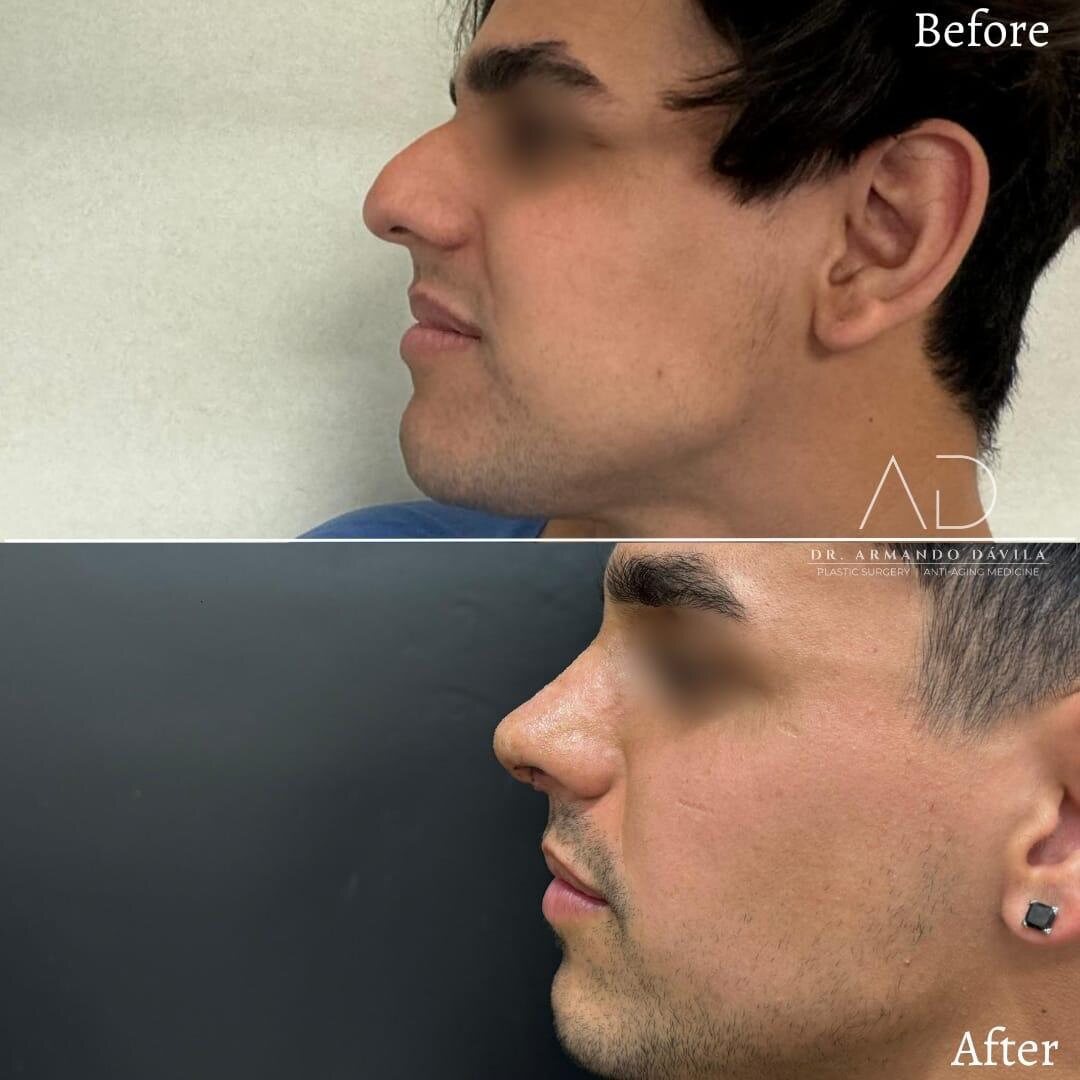 Antes y después de una rinoplastia secundaria ultrasónica