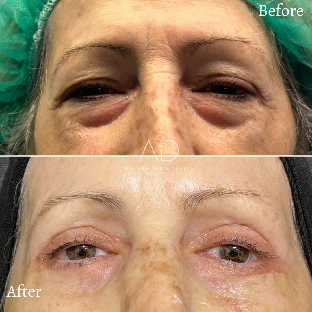 Antes y después de una blefaroplastia